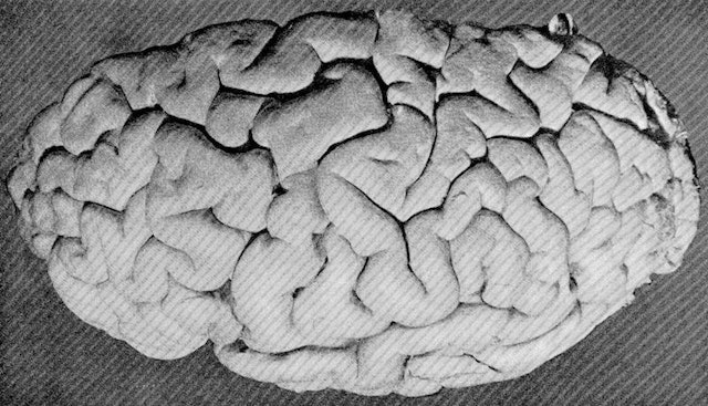 A Description of the Brain of Mr. Charles Babbage (1909)