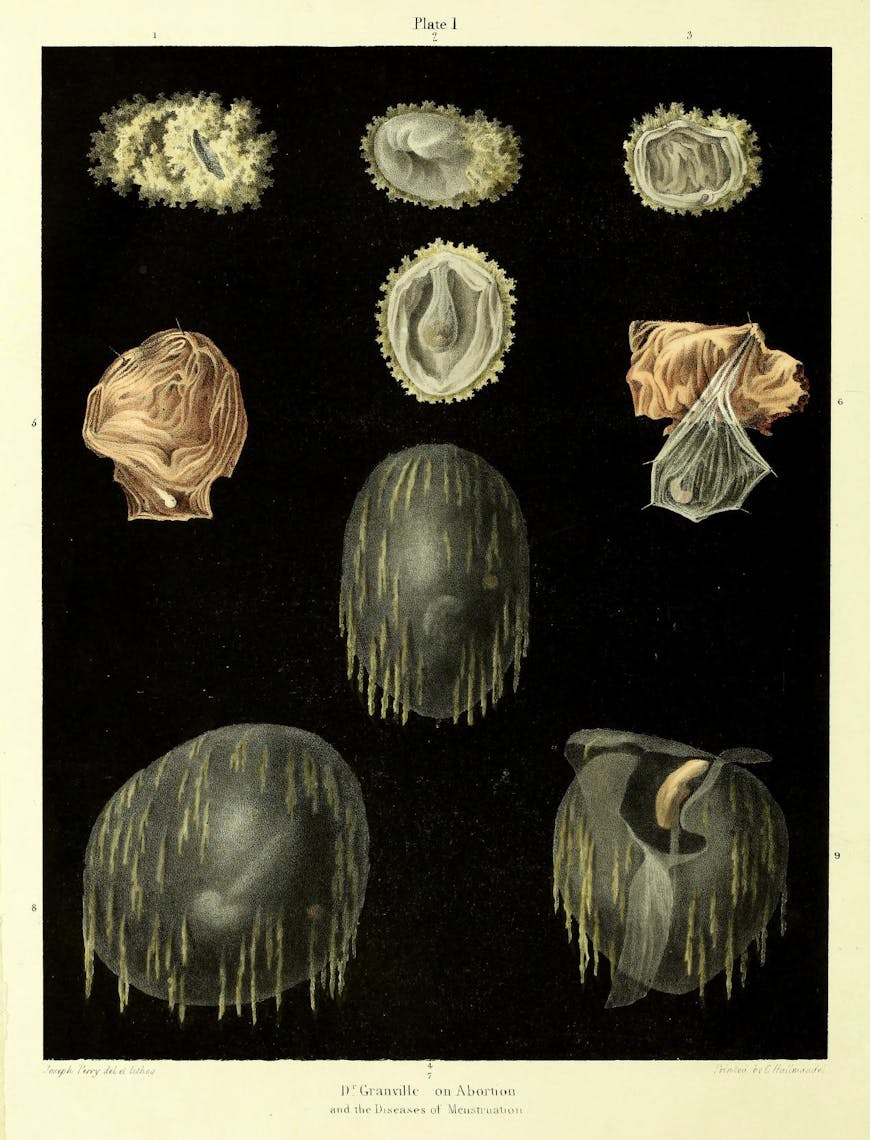 19th-century illustration of miscarriage