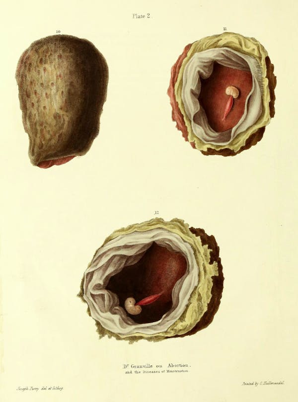 19th-century illustration of miscarriage