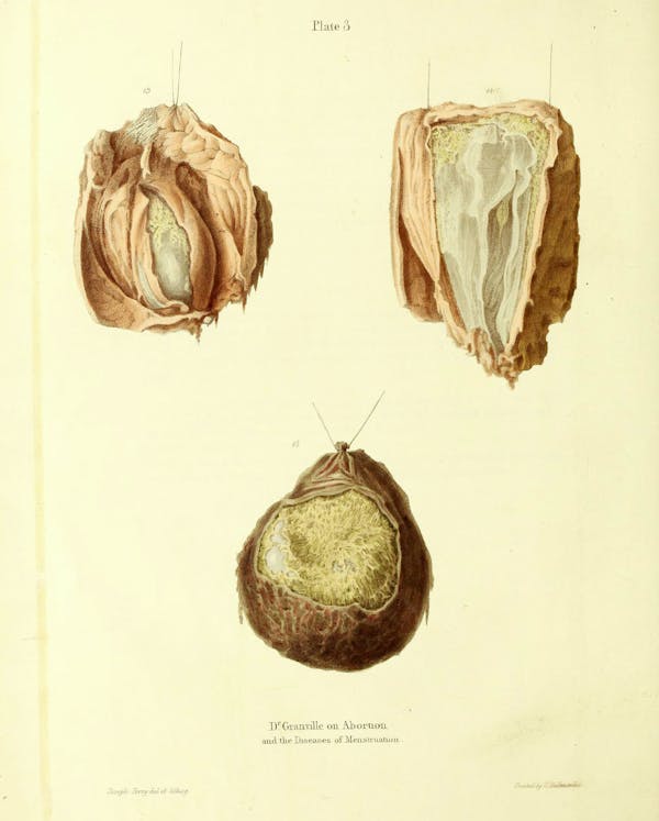 19th-century illustration of miscarriage