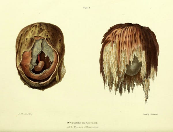 19th-century illustration of miscarriage