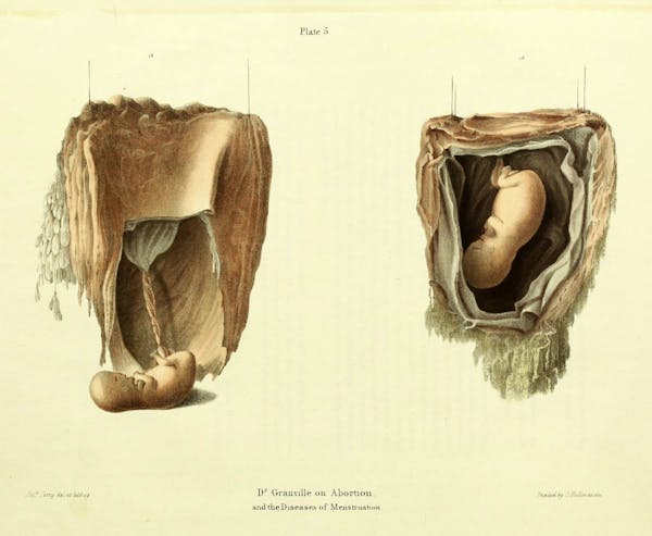 19th-century illustration of miscarriage