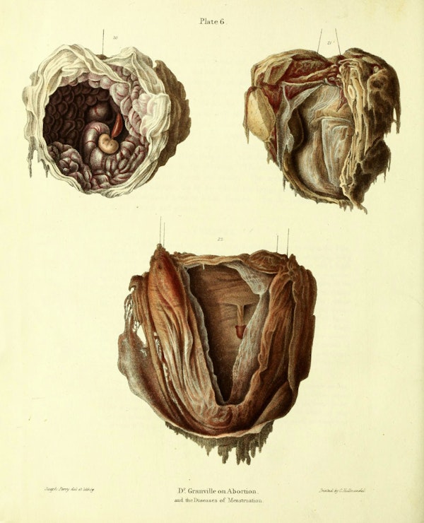19th-century illustration of miscarriage