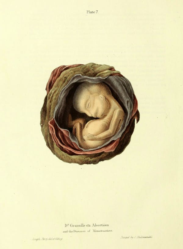 19th-century illustration of miscarriage