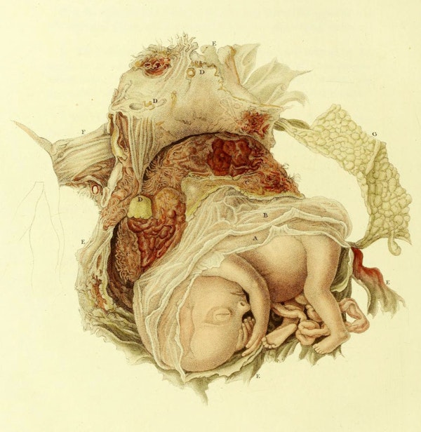 19th-century illustration of miscarriage