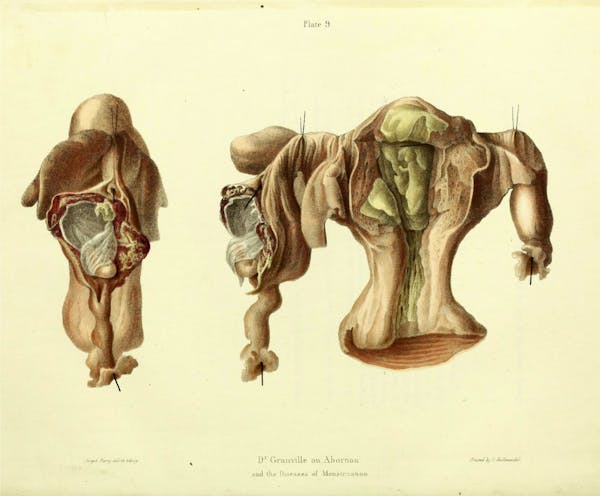 19th-century illustration of miscarriage