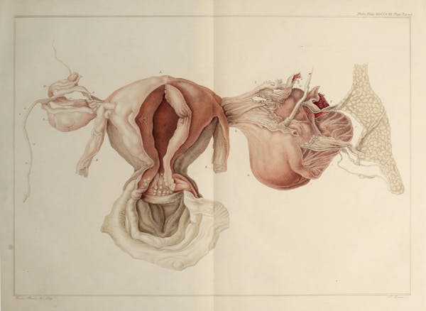 19th-century illustration of miscarriage