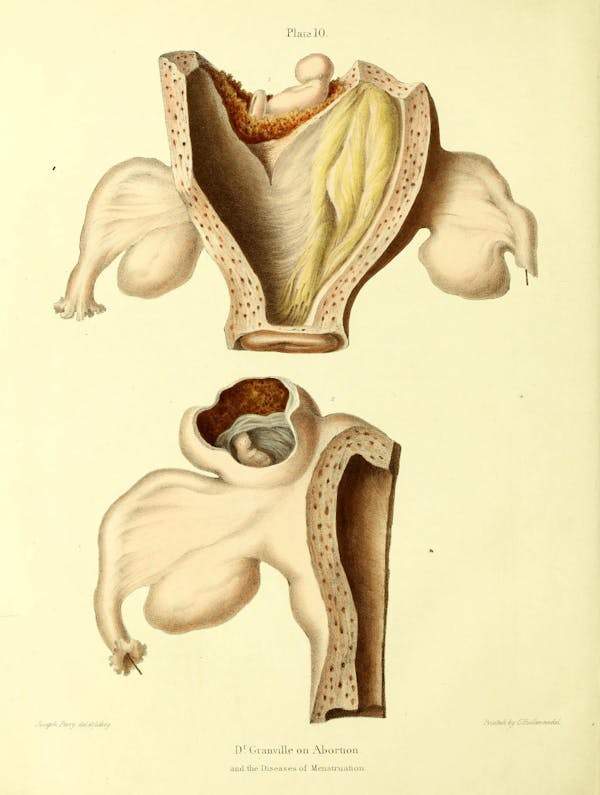 19th-century illustration of miscarriage