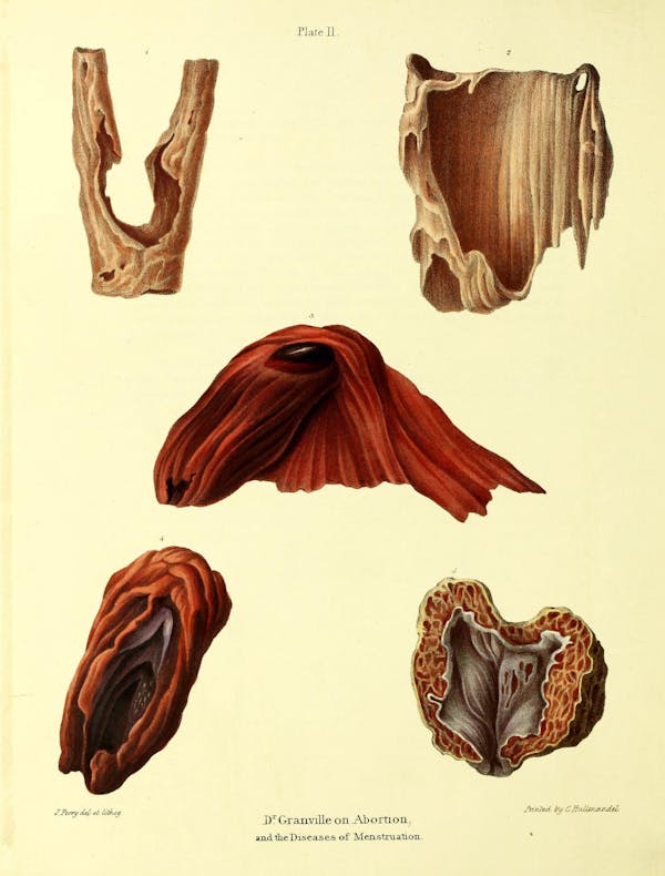 19th-century illustration of miscarriage