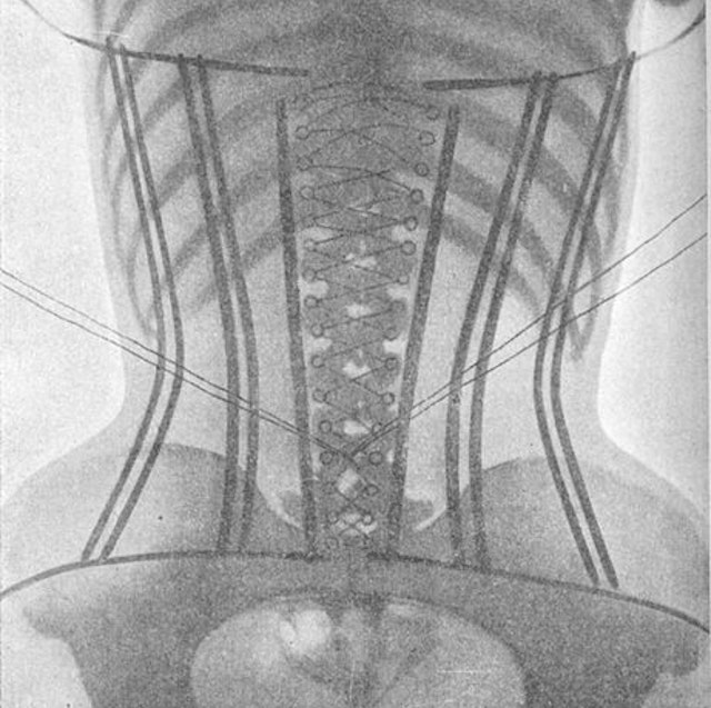 The Corset X-Rays of Dr Ludovic O’Followell (1908)
