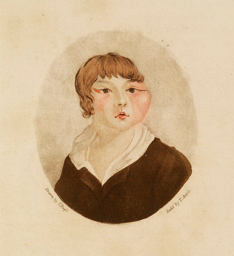 early vaccination image ox-faced boy