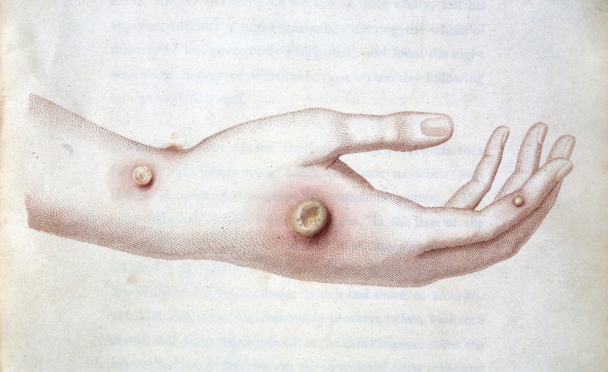 cowpox infection